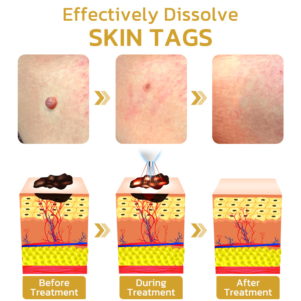 Caneta de beleza elétrica profissional Remifa™ Spotifly