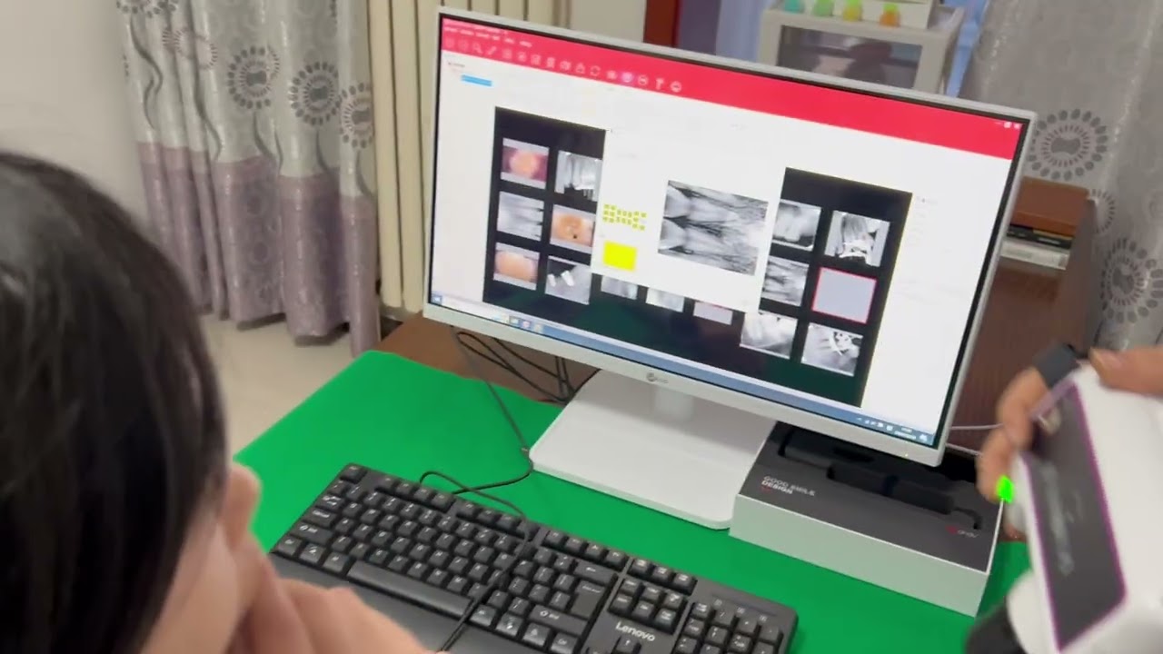 Dental Rvg Sensor APS CMOS Technology