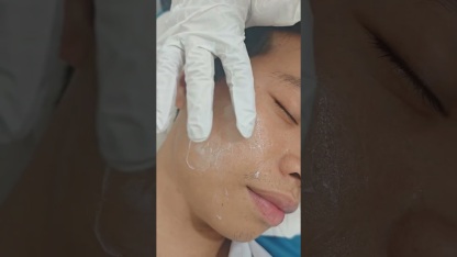 Portable Rf Microneedling Face Lift Skin Tighten