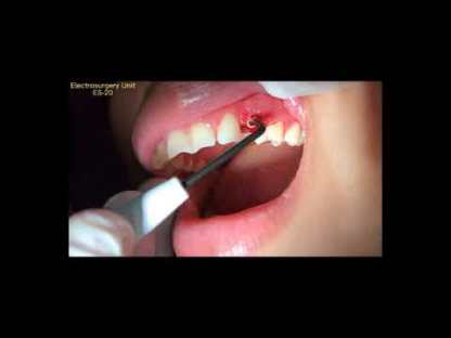 Dental Electrosurgery High Frequency Surgical Scalpel Unit