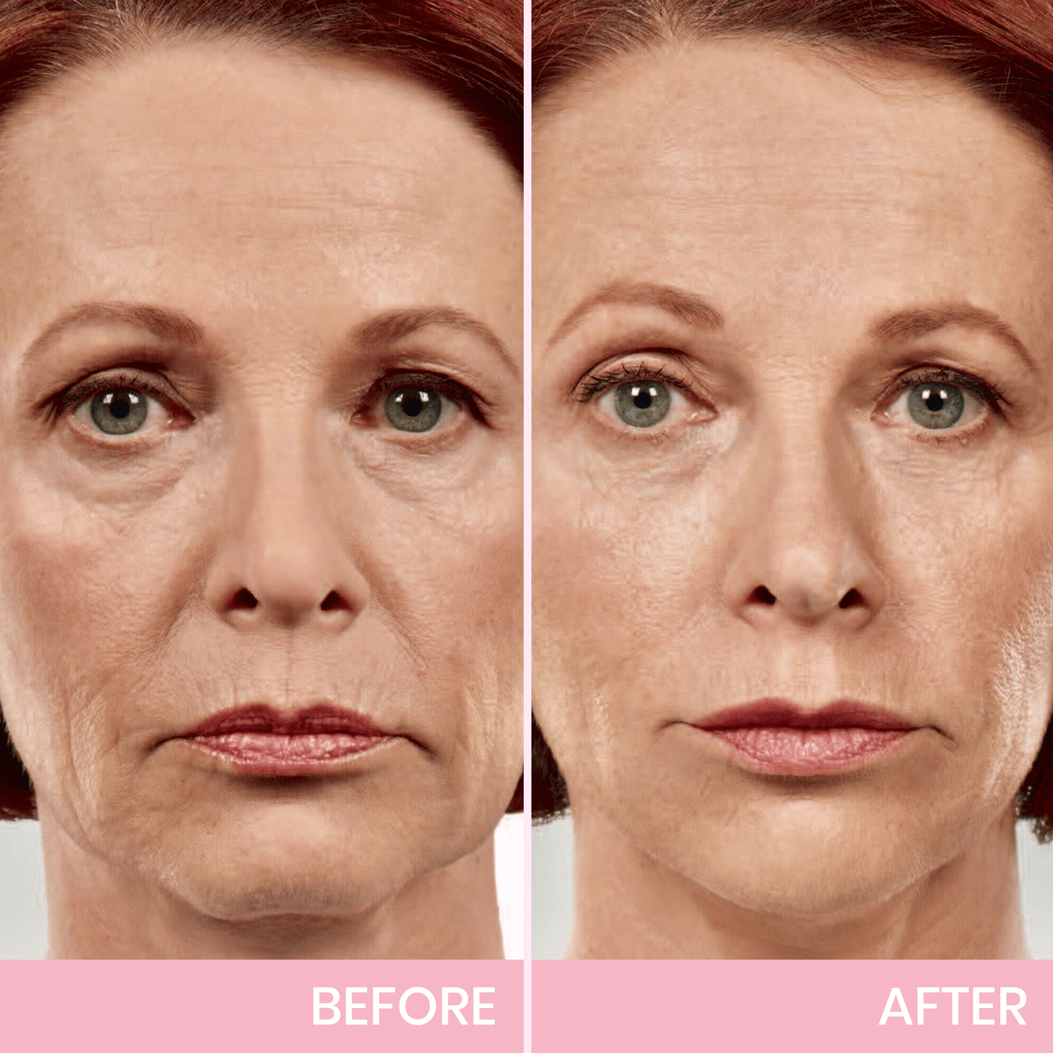 V-Face👑Lifting Invisible Adhesive Tape