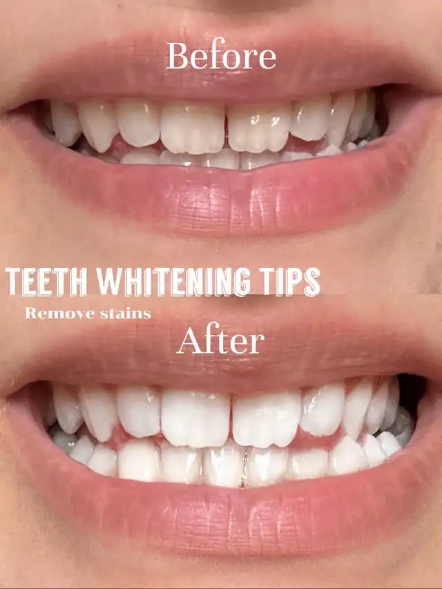 Teeth Whitening Powder | Instant Whitening and Stain Removal