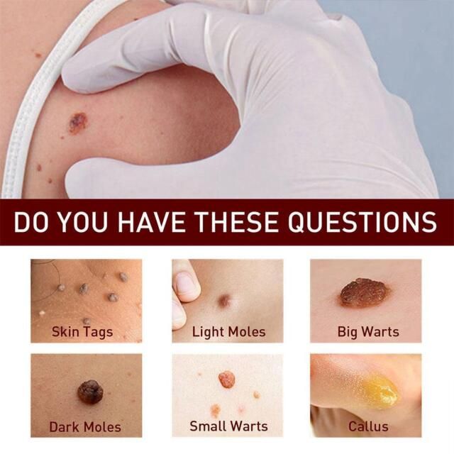 Tags & Moles Remover