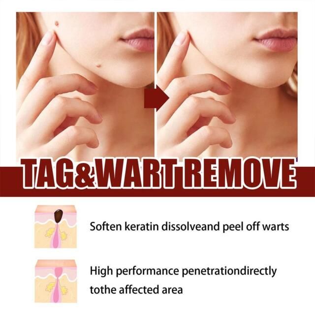 Tags & Moles Remover
