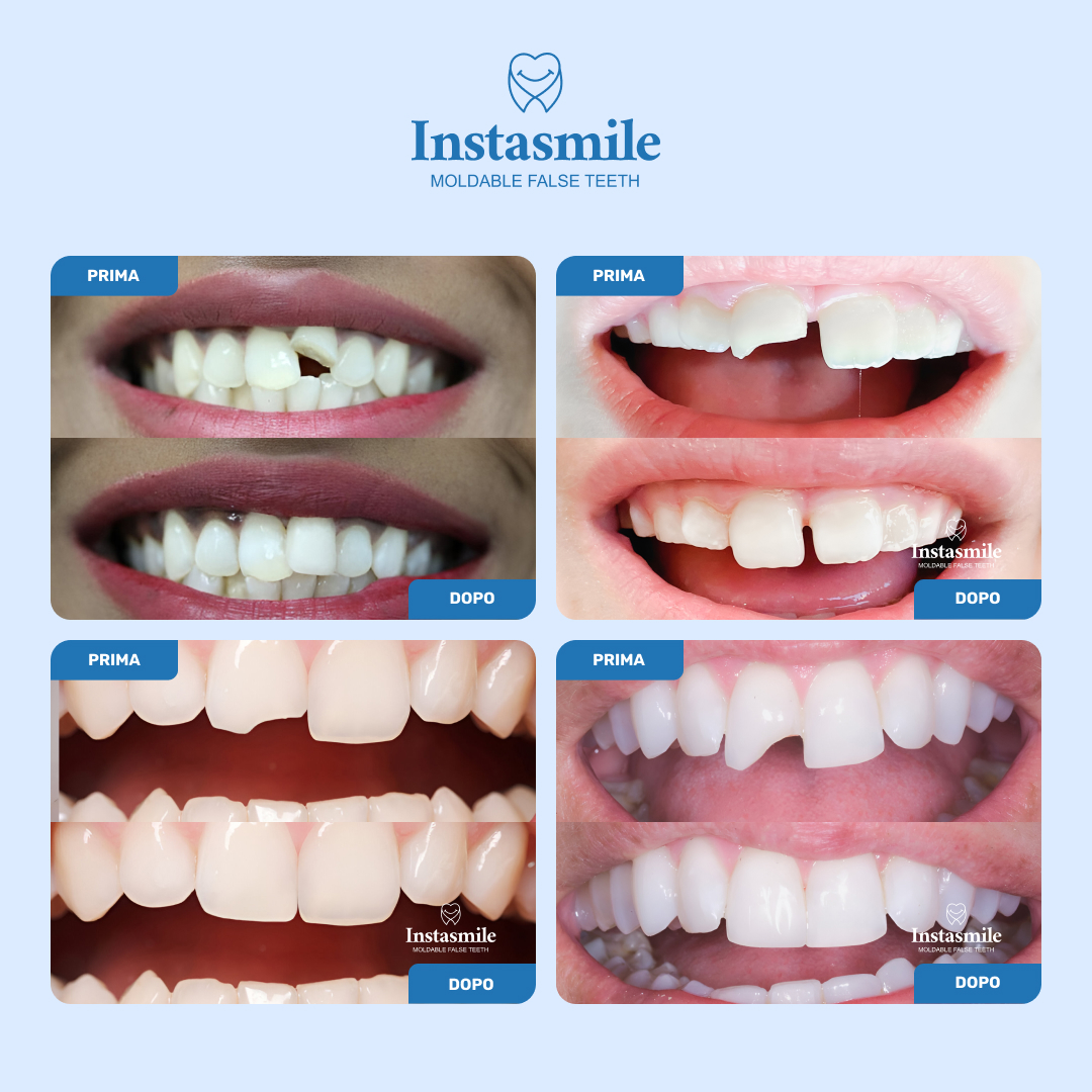 🔥Last Day Buy 50% OFF🔥 InstaSmile Tooth Repair Kit-Buy 1 Get 1 Free😍