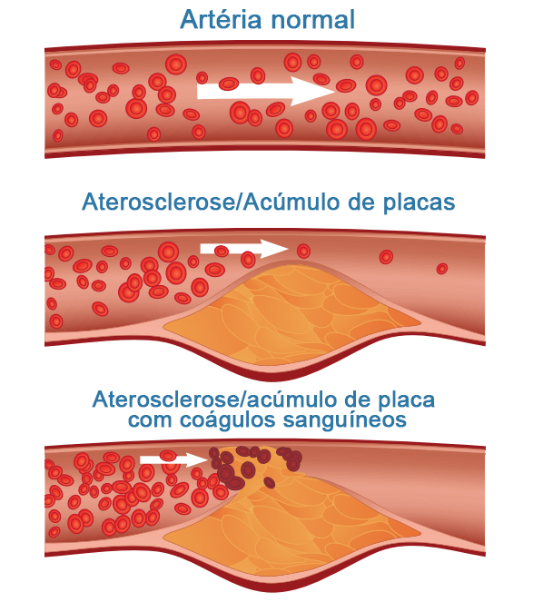 1705914468706690.jpg atherosclerosis.jpg