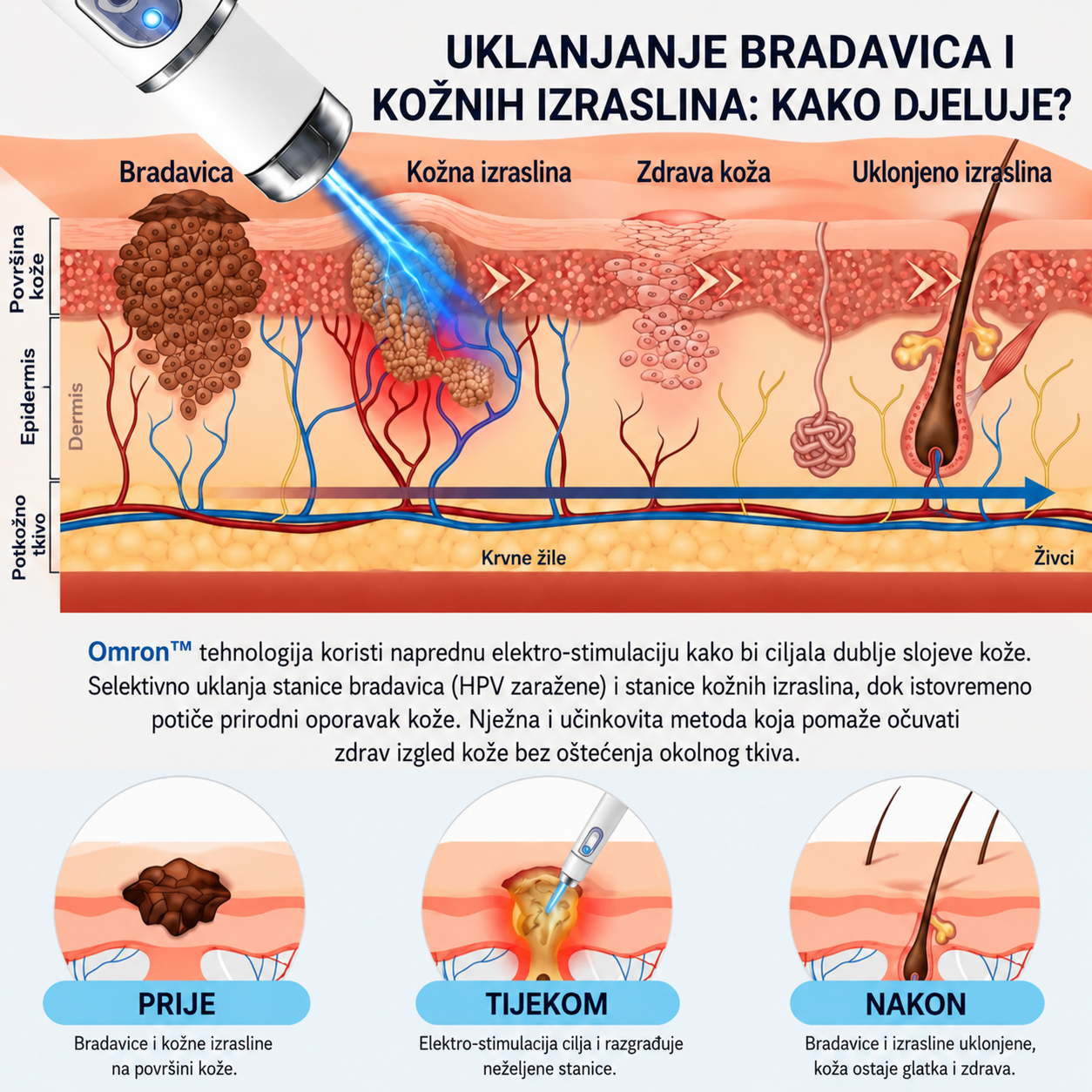 ✨ Omron™ 2026 nova generacija višenamjenske olovke za njegu kože – profesionalno rješenje za uklanjanje madeža i nepravilnosti na koži. Bezbolna i neinvazivna tehnologija bez ožiljaka za zdraviju i blistaviju kožu. Proizvedeno u SAD-u. ✨