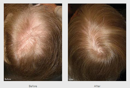 Male pattern baldness Information | Mount Sinai - New York