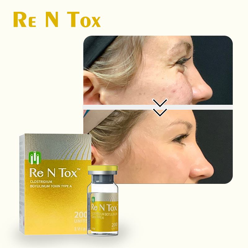 Botulinum Toxin effect