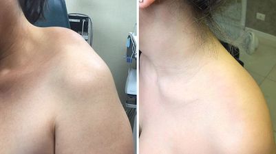 LIMETOW™Bee Venom Professional Treatment Gel