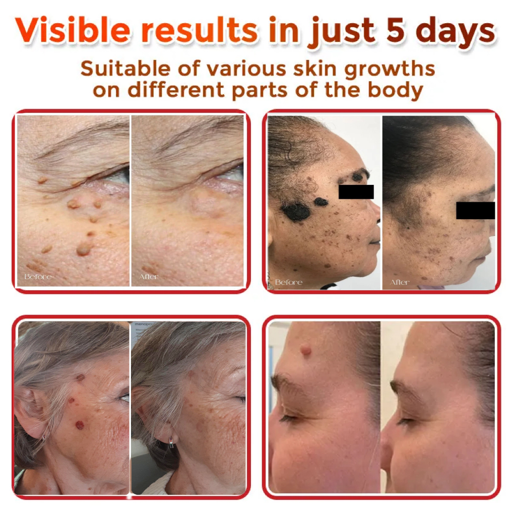 🔥Buy 1 Get 1 Free🔥Pain-free Bee Venom Wart and Tags Removoal Cream — Made for all skin types