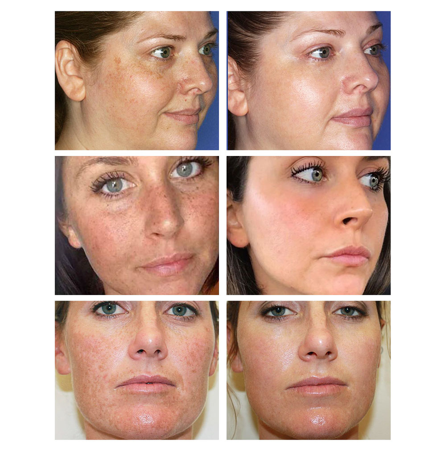 10% Niacinamide Spots Removal Serum