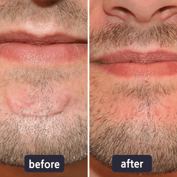 Quickly Fade New and Old Scars & Tighten Skin Repair Cream | Safe, Gentle & Suitable for Sensitive Skin