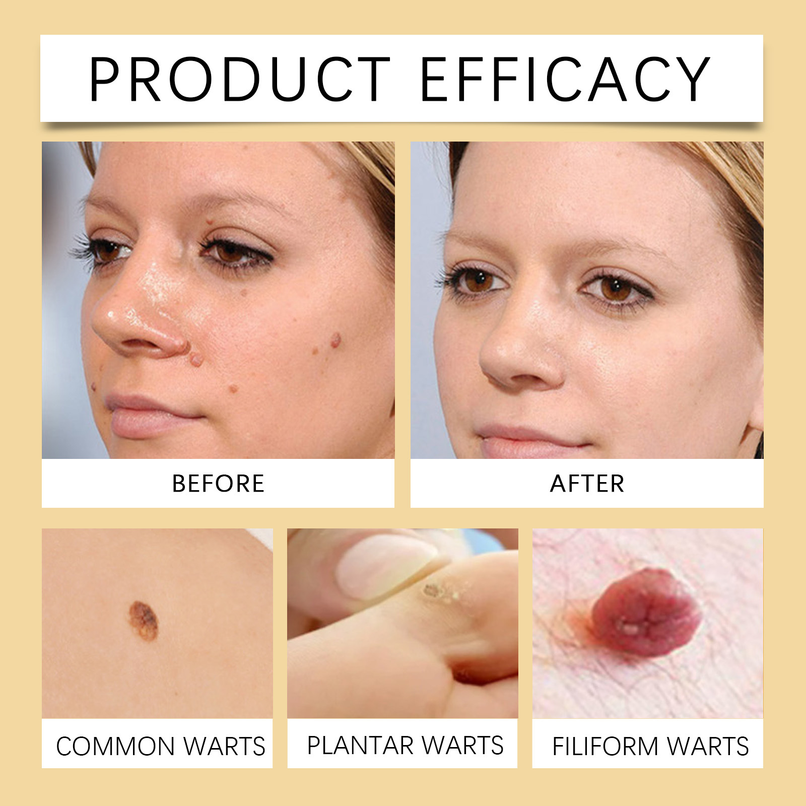 🔥Buy 1 Get 1 Free🔥Pain-free Bee Venom Wart and Tags Removoal Cream — Made for all skin types