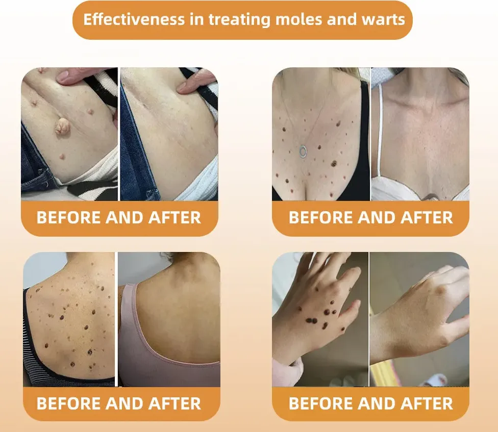 🍃[👨&zwj;⚕AAD RECOMMENDS]  Bee Venom Mole and Wart Treatment Cream🔥Limited time 50% OFF🔥( Suitable for use byindividuals of all ages)