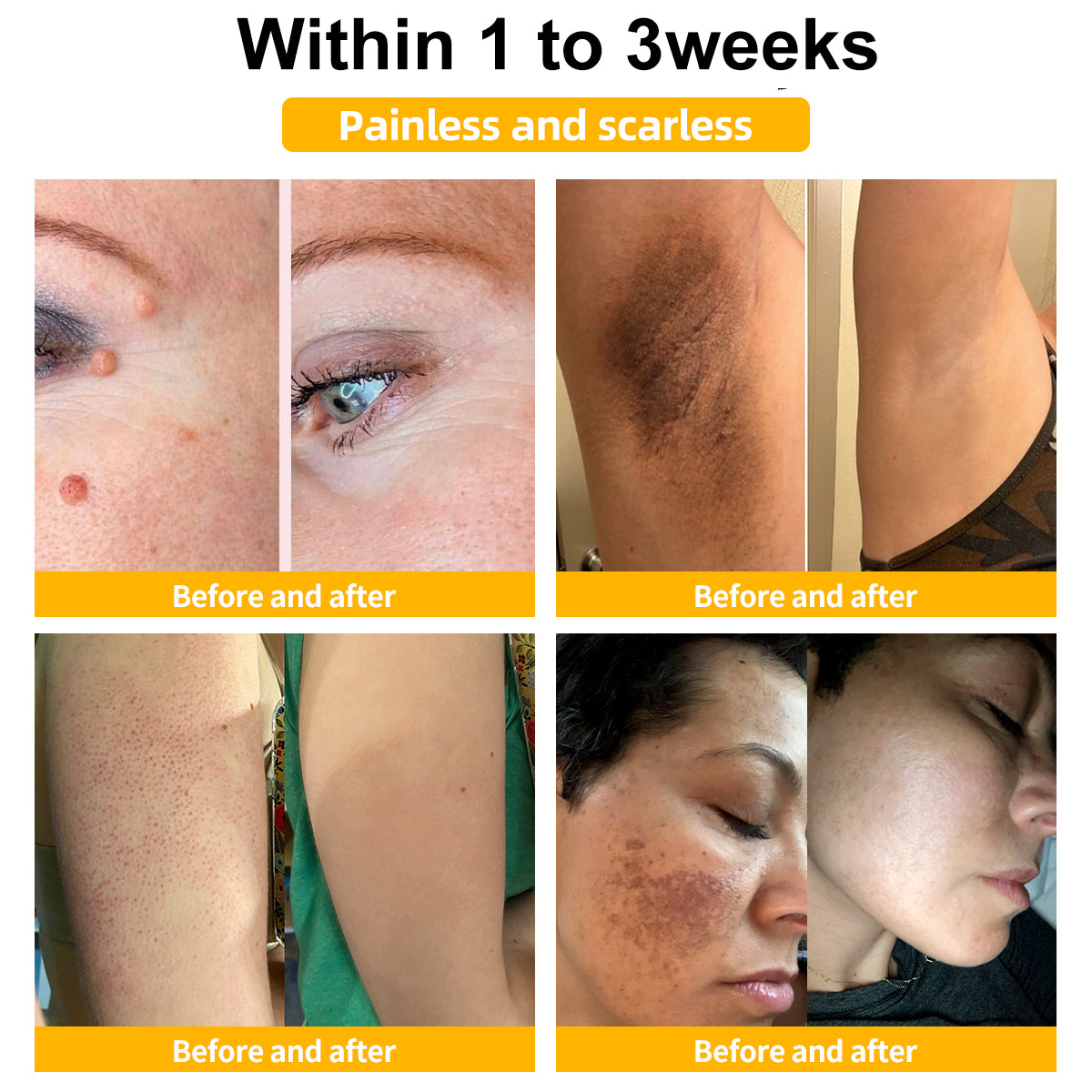 🍃[👨‍⚕AAD RECOMMENDS]  Bee Venom Mole and Wart Treatment Cream🔥Limited time 50% OFF🔥( Suitable for use byindividuals of all ages)