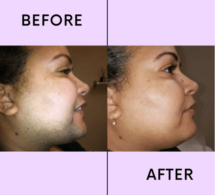 🔥Buy 1 Get 1 Free-✨Hair Removal Kit