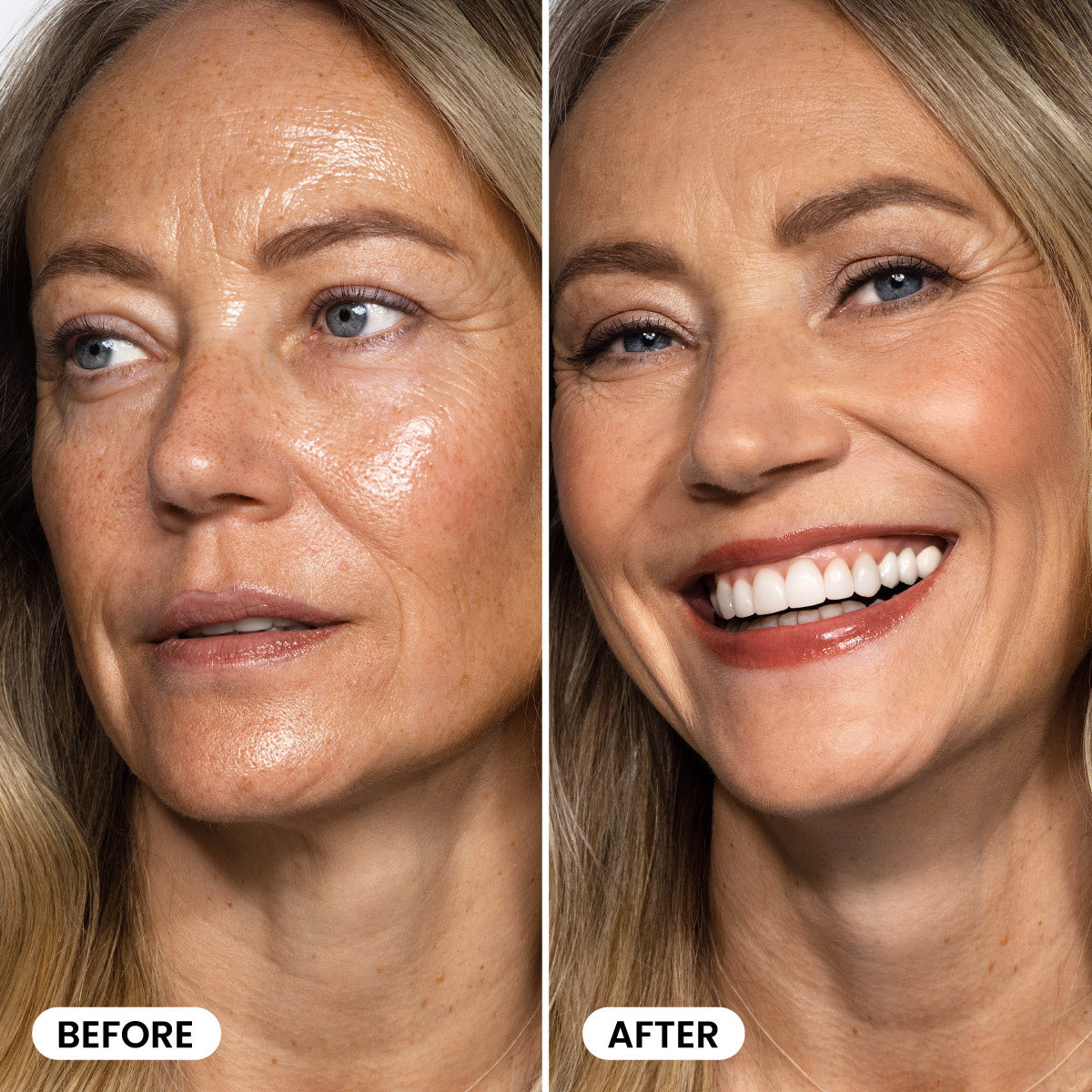 Side-by-side comparison of a womans face, labeled Before (left) showing uneven skin tone and texture, and After (right) with smoother, brighter skin and a wide smile.