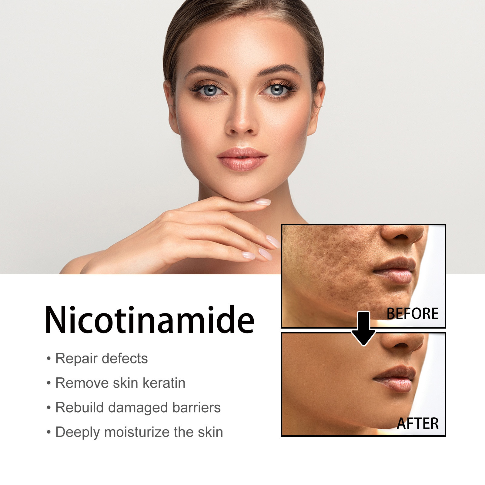 🔥Buy 1 Get 1 Free🔥Niacinamide Spot Correcting Anti-Acne Serum