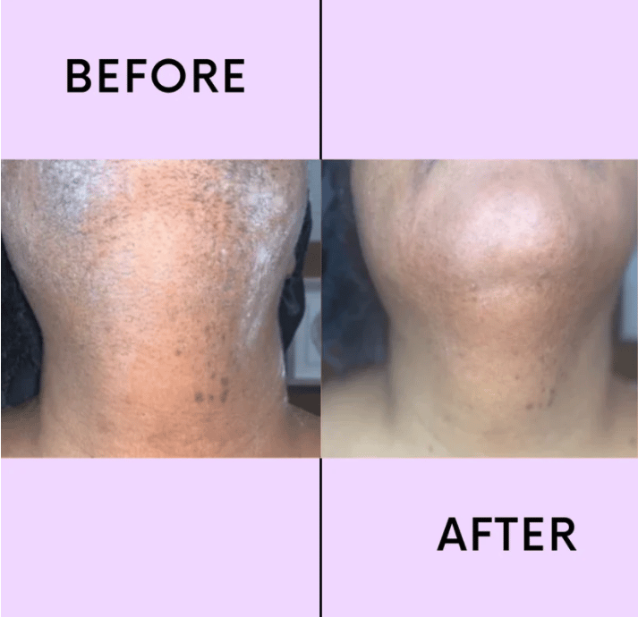 🔥Buy 1 Get 1 Free-✨Hair Removal Kit