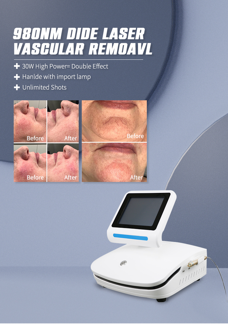 blood vessels removal spider vein removal 980nm portable beauty machine