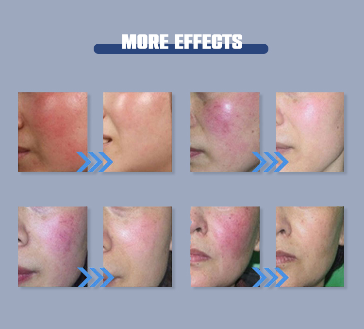 blood vessels removal spider vein removal 980nm portable beauty machine