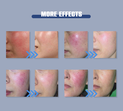 blood vessels removal spider vein removal 980nm portable beauty machine