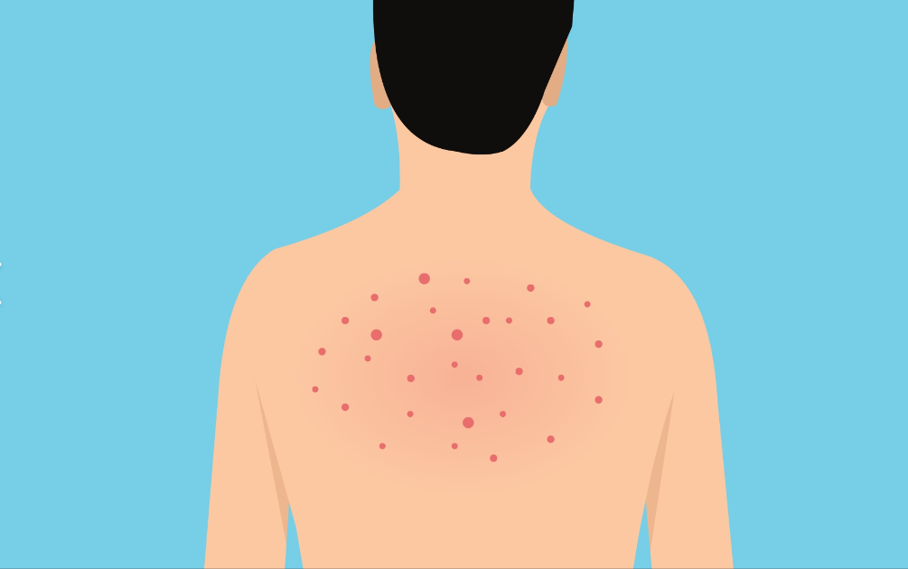 Bid Farewell to Pesky Back Acne!-GLM Beauty Spa Equipment Factory