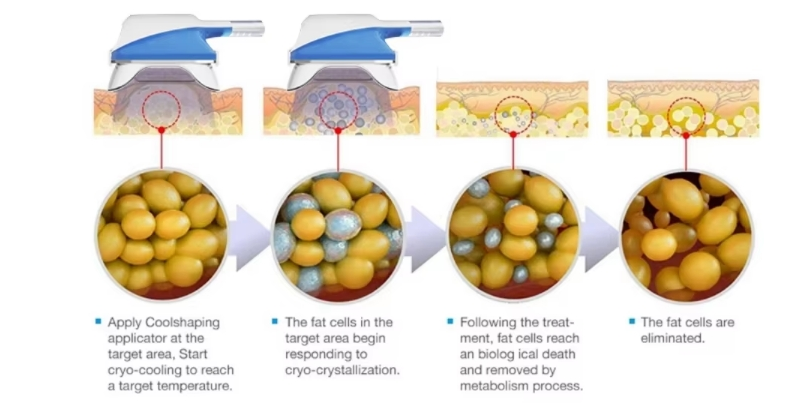 Ultrasonic Frequency's Role in Fat Reduction-GLM Beauty Spa Equipment Factory