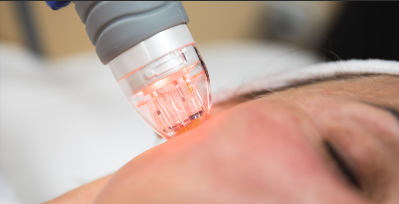 Do RF microneedles really work-GLM Beauty Spa Equipment Factory