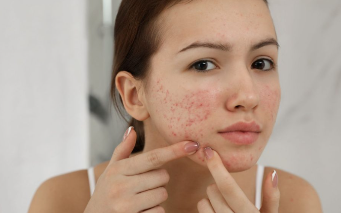 Effective way to get rid of acne-GLM Beauty Spa Equipment Factory