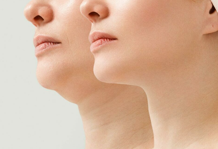 What are the benefits of Ultrasonic HIFU, RF, and frozen fat treatments?-GLM Beauty Spa Equipment Factory