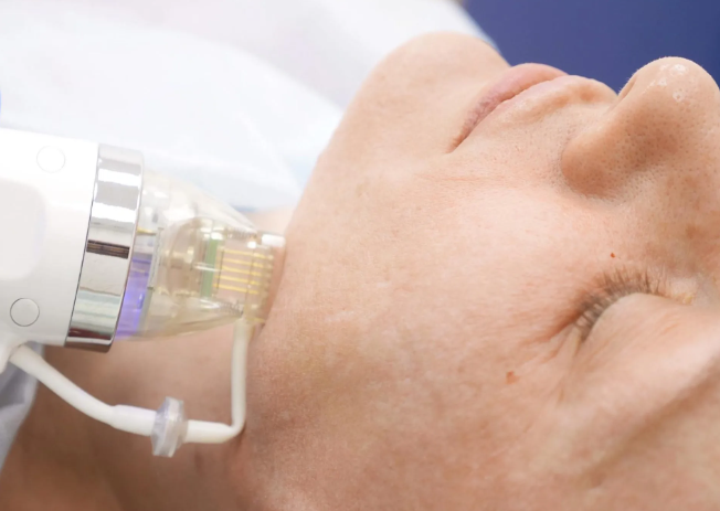 Does microneedle therapy work?-GLM Beauty Spa Equipment Factory