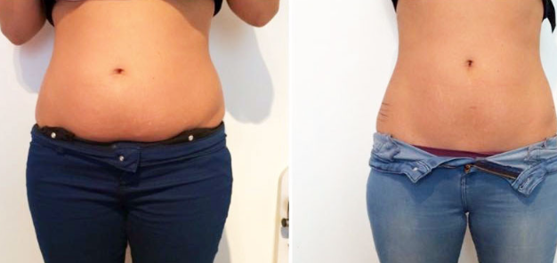How does laser fat removal compare to fat reduction through cavitation?-GLM Beauty Spa Equipment Factory