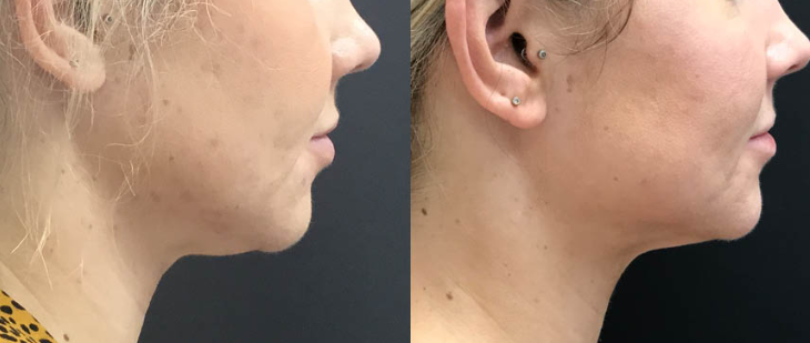 CoolSculpting vs. Kybella: Which is best for your chin?-GLM Beauty Spa Equipment Factory