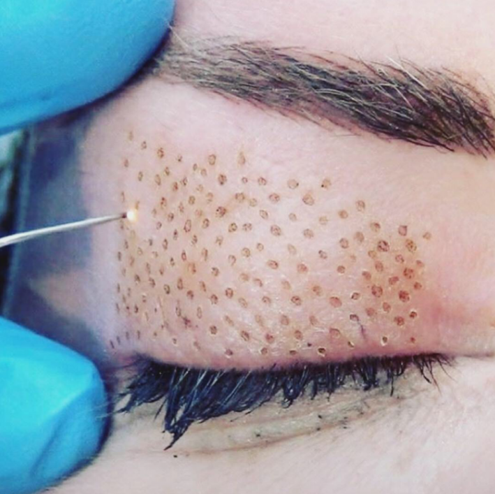 Plasma Pen for Skin Repair-GLM Beauty Spa Equipment Factory