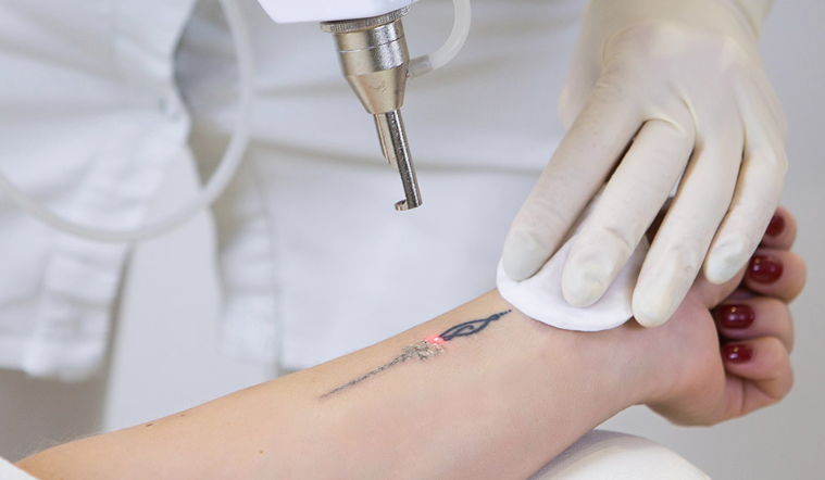 The ultimate guide to laser tattoo removal machines-GLM Beauty Spa Equipment Factory