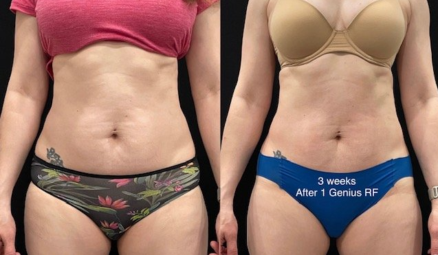 What is the safest fat removal procedure?-GLM Beauty Spa Equipment Factory