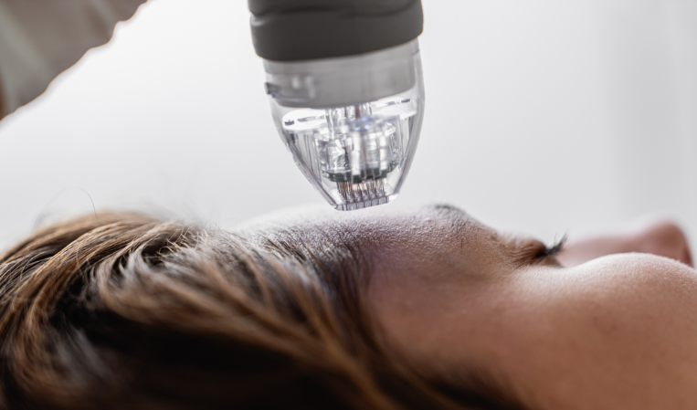 What is the impact of radio-frequency microneedle on facial collagen synthesis?-GLM Beauty Spa Equipment Factory