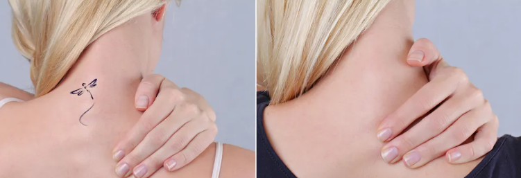 Laser Tattoo Removal: Unmasking the Power of Laser Technology-GLM Beauty Spa Equipment Factory
