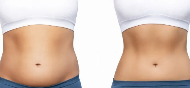 How should I choose between ultrasonic cavitation and laser fat loss-GLM Beauty Spa Equipment Factory