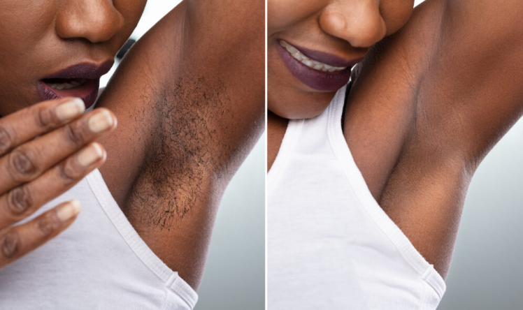 The Ultimate Guide to Laser Hair Removal: Unveiling the Most Popular Method-GLM Beauty Spa Equipment Factory