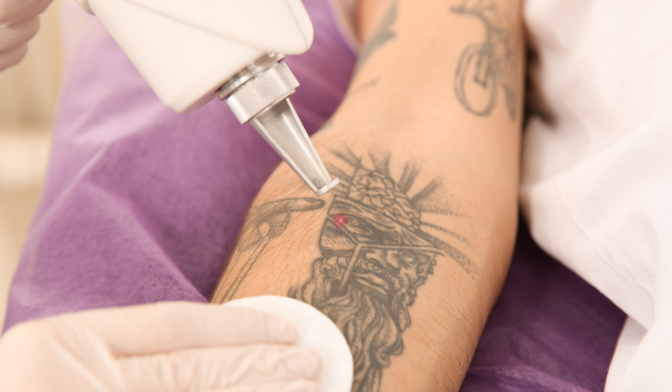 Which laser is the most suitable for removing tattoos?-GLM Beauty Spa Equipment Factory