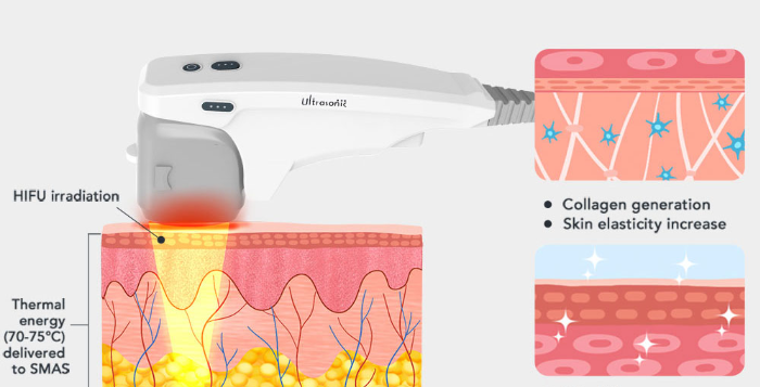 Understand the comprehensive guide to Ultrasound Knife Medical spas-GLM Beauty Spa Equipment Factory