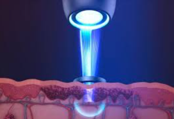 The best way to treat acne scars in a clinic-GLM Beauty Spa Equipment Factory