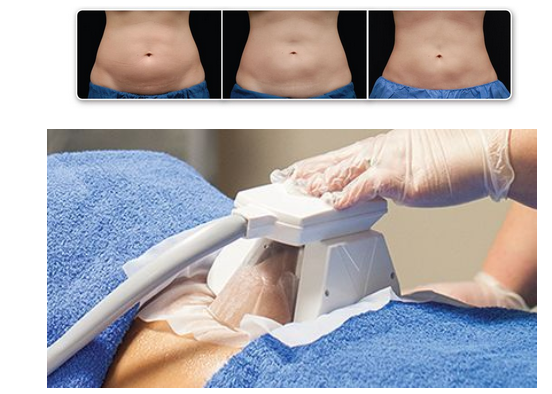 How does cryolipolysis target fat without harming the body?-GLM Beauty Spa Equipment Factory