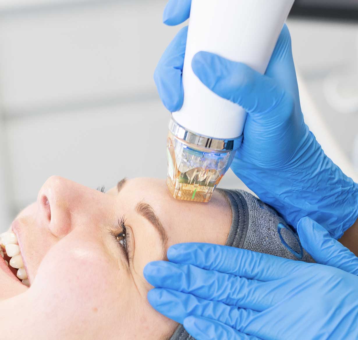 Radio Frequency (RF) Microneedling Nottingham | Pro Aesthetics