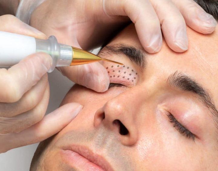 Multi Plasma Treatment - Unique Beauty & Laser Clinic