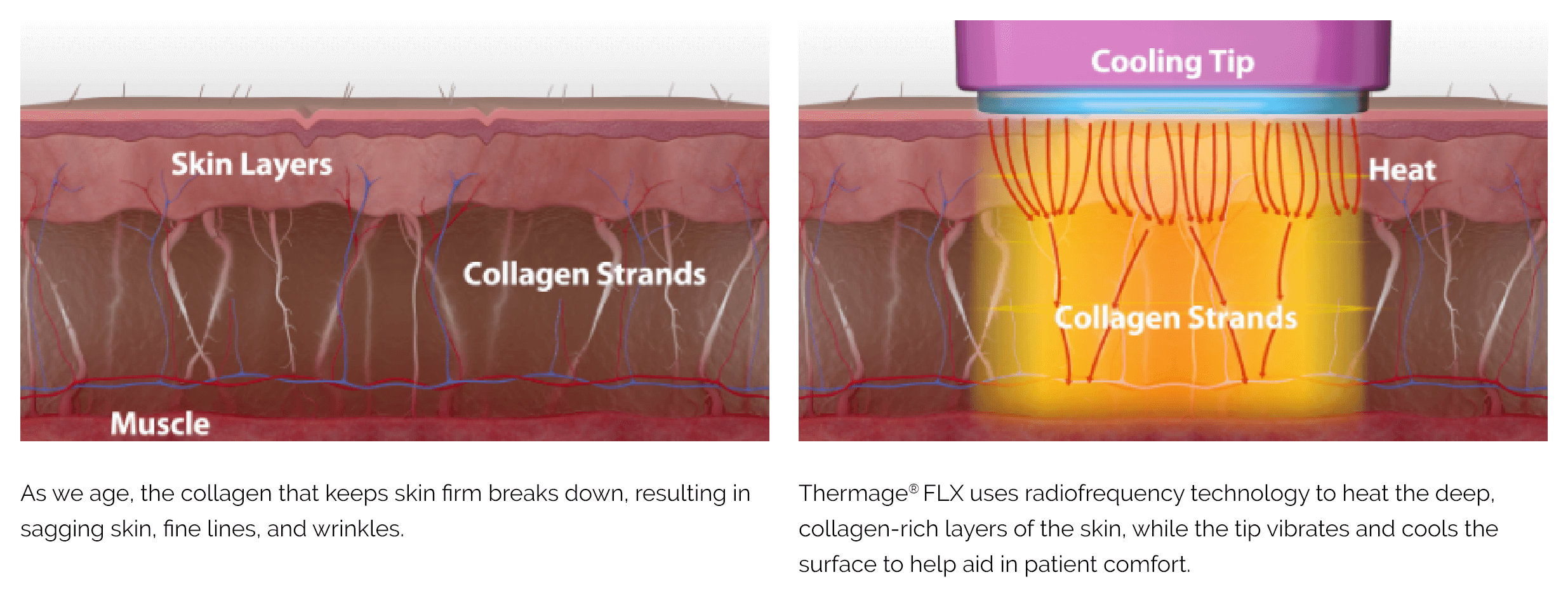 Thermage - MyClinic | Aesthetic Clinic Malaysia