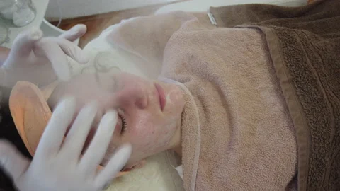 Acne treatment of problematic face skin ... | Stock Video | Pond5